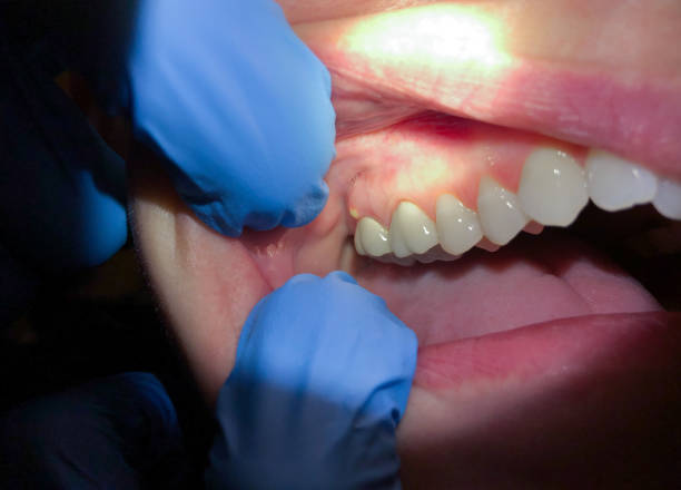 Best Broken or Cracked Tooth Emergency Dentist in Batesville, IN